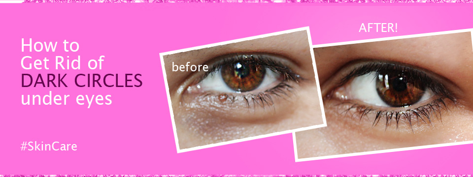 how to get rid of dark under eye circles fast naturally