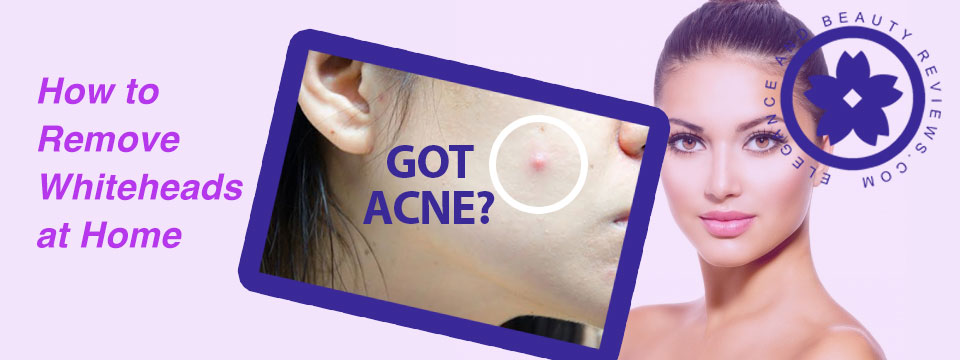How to get rid of whiteheads fast at home