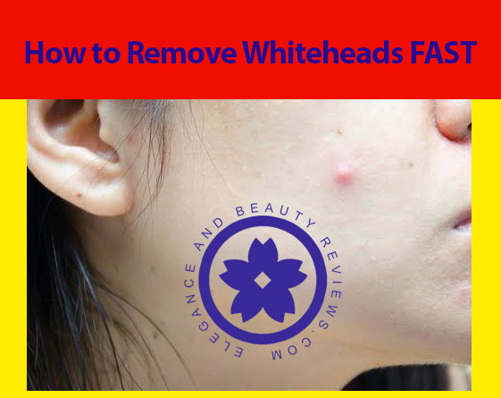How to Get Rid of Whiteheads Fast at Home How to Get Rid of Whiteheads Fast at Home